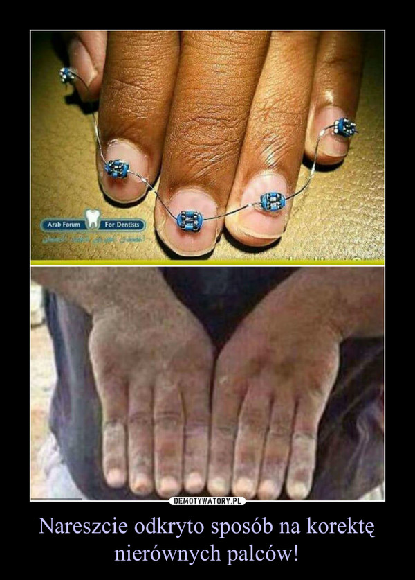Nareszcie odkryto sposób na korektę nierównych palców! –  